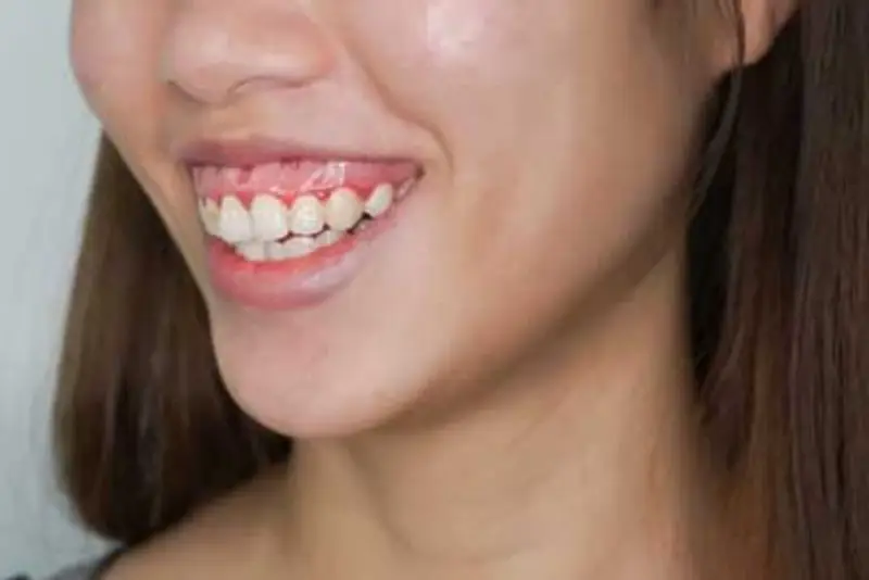 cười hở lợi thì sao