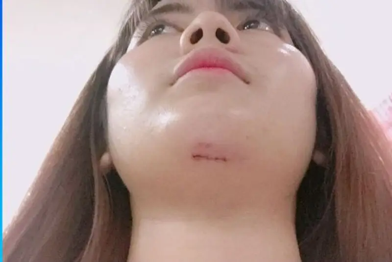 Xuất hiện sẹo sau phẫu thuật độn cằm nếu sai kỹ thuật phẫu thuật