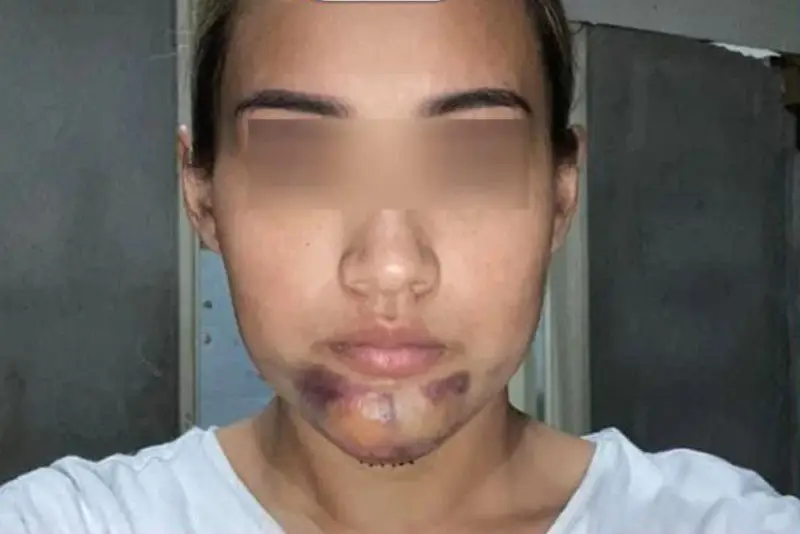 Tụ máu, bầm tím vùng cằm