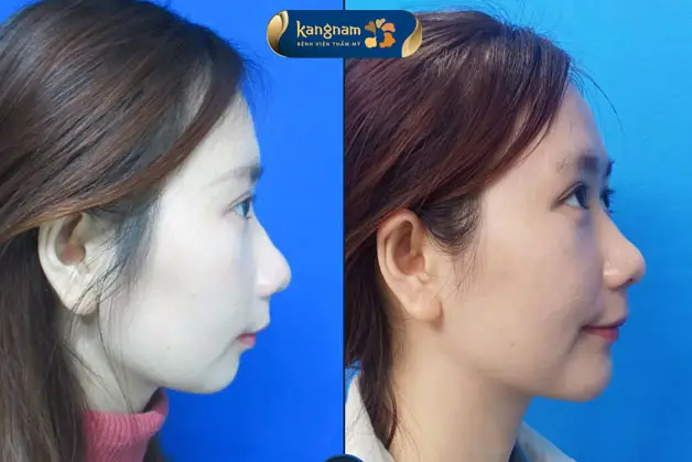 Dáng cằm cân đối và hài hòa