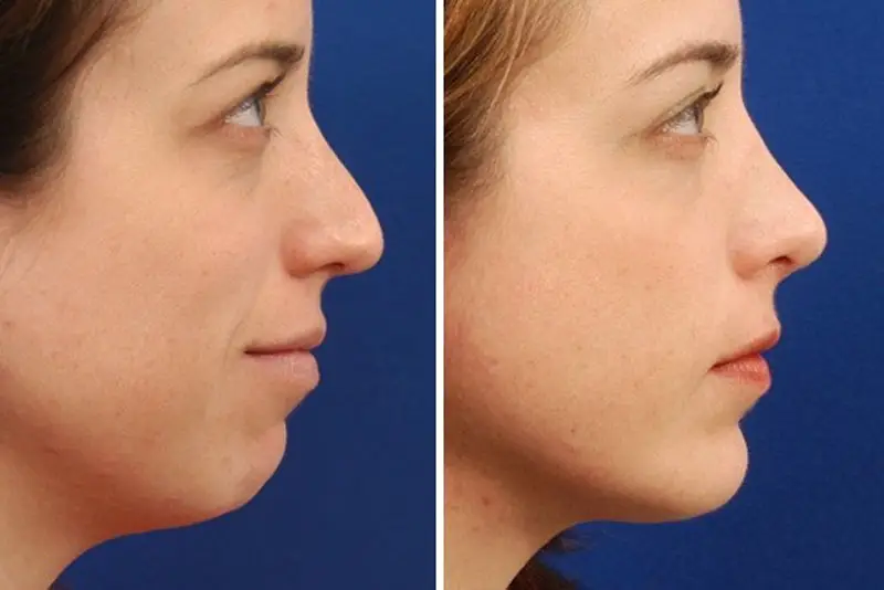 Chăm sóc đúng cách giúp vùng cằm nhanh hồi phục và đạt kết quả tự nhiên