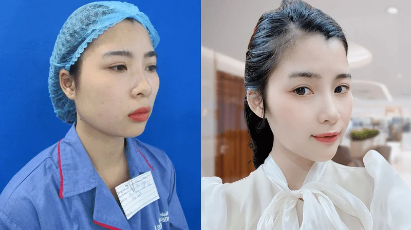 Cằm V-line rõ nét hơn, tạo cảm giác thanh thoát cho khuôn mặt