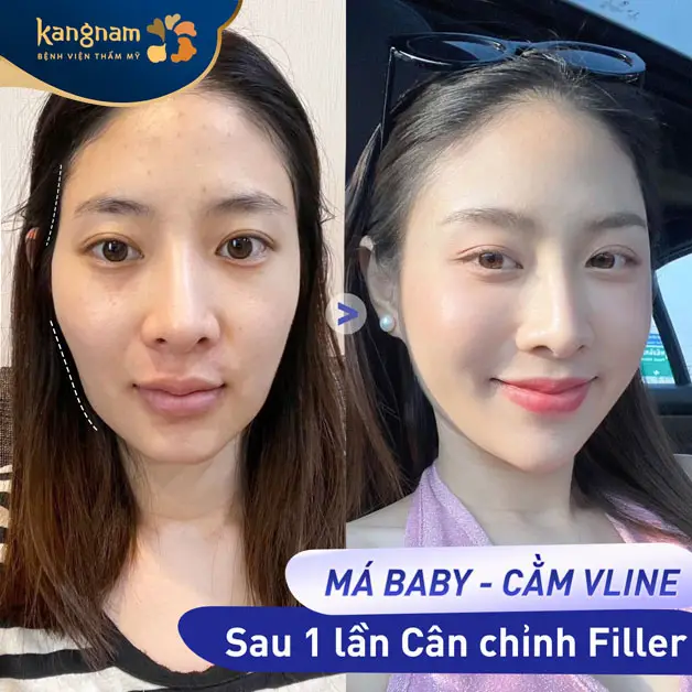 Sở hữu gương mặt cân đối sau khi tiêm má và cằm