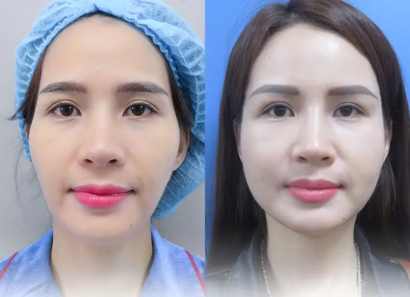 khuôn mặt thay đổi khác biệt sau khi cấy mỡ lên mặt