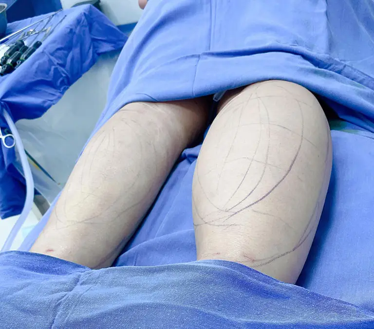 Hút mỡ bắp chân là phương pháp thẩm mỹ loại bỏ mỡ thừa nhanh chóng
