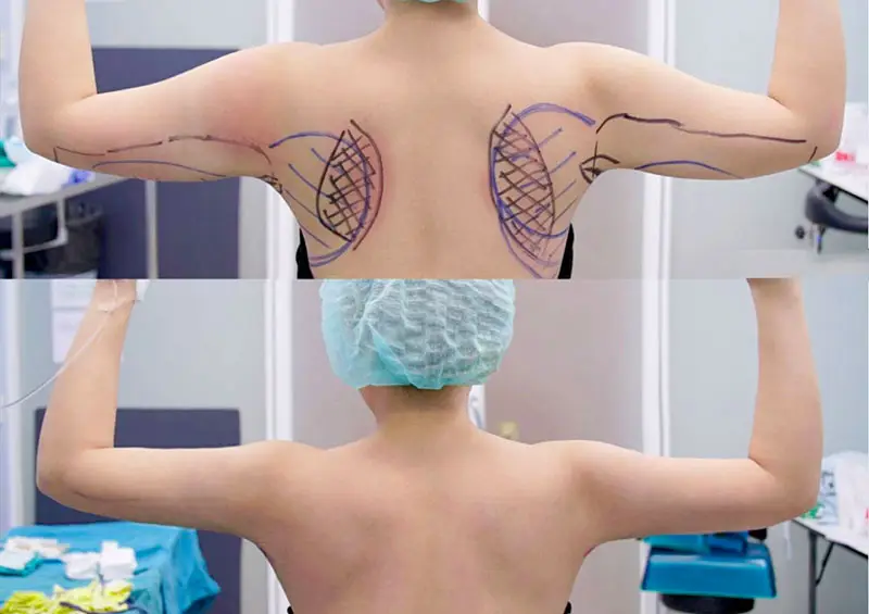 Giảm mỡ nách bằng phương pháp hút mỡ giúp loại bỏ mỡ thừa nhanh chóng