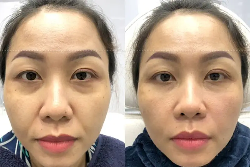 GIảm quầng thâm rõ rệt sau khi tiêm