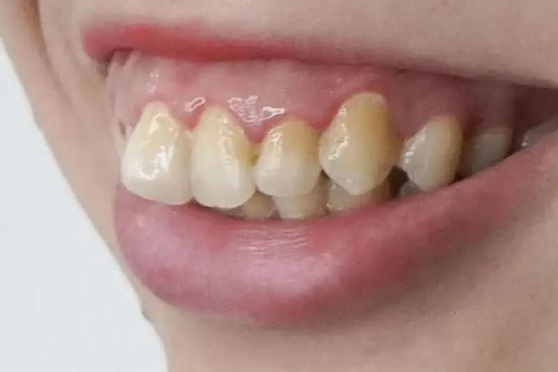 Hàm hô tái phát có thể xảy ra nếu kỹ thuật phẫu thuật không chính xác