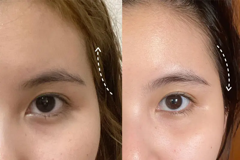 Kết quả ổn định sau phẫu thuật độn thái dương