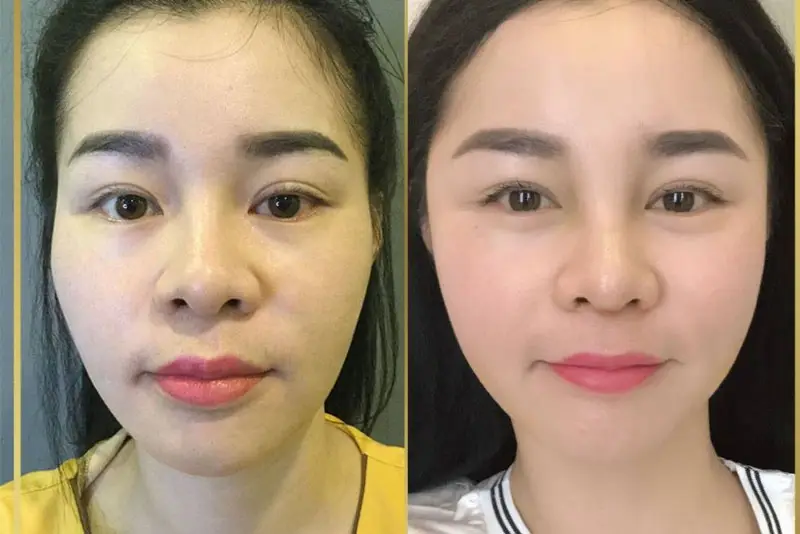 Kết quả ổn định sau phẫu thuật độn thái dương