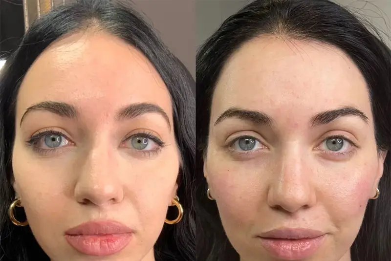 Khách hàng trước và sau khi độn thái dương