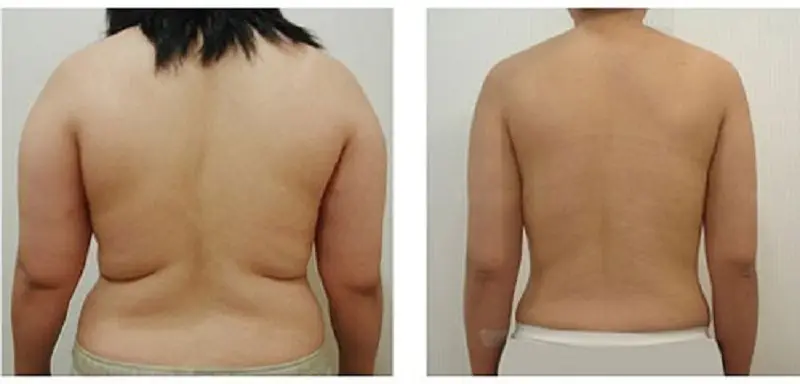 Sau hút mỡ bả vao giúp vùng vai thon gọn, săn chắc