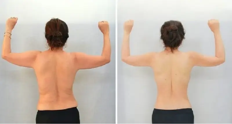 Thực hiện tại địa chỉ thẩm mỹ uy tín để tránh gây biến chứng sau hút mỡ bả vai