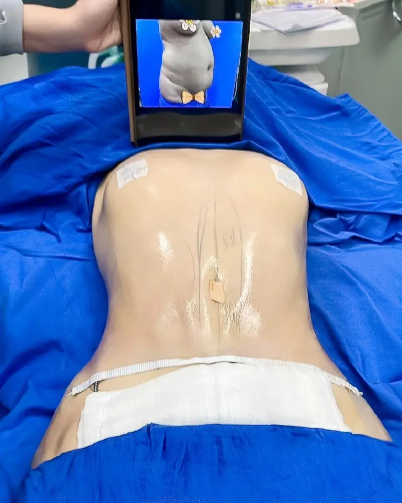 Trong những ngày đau sau hút mỡ bụng vòng 2 vẫn còn hơi sưng tấy và đau nhức