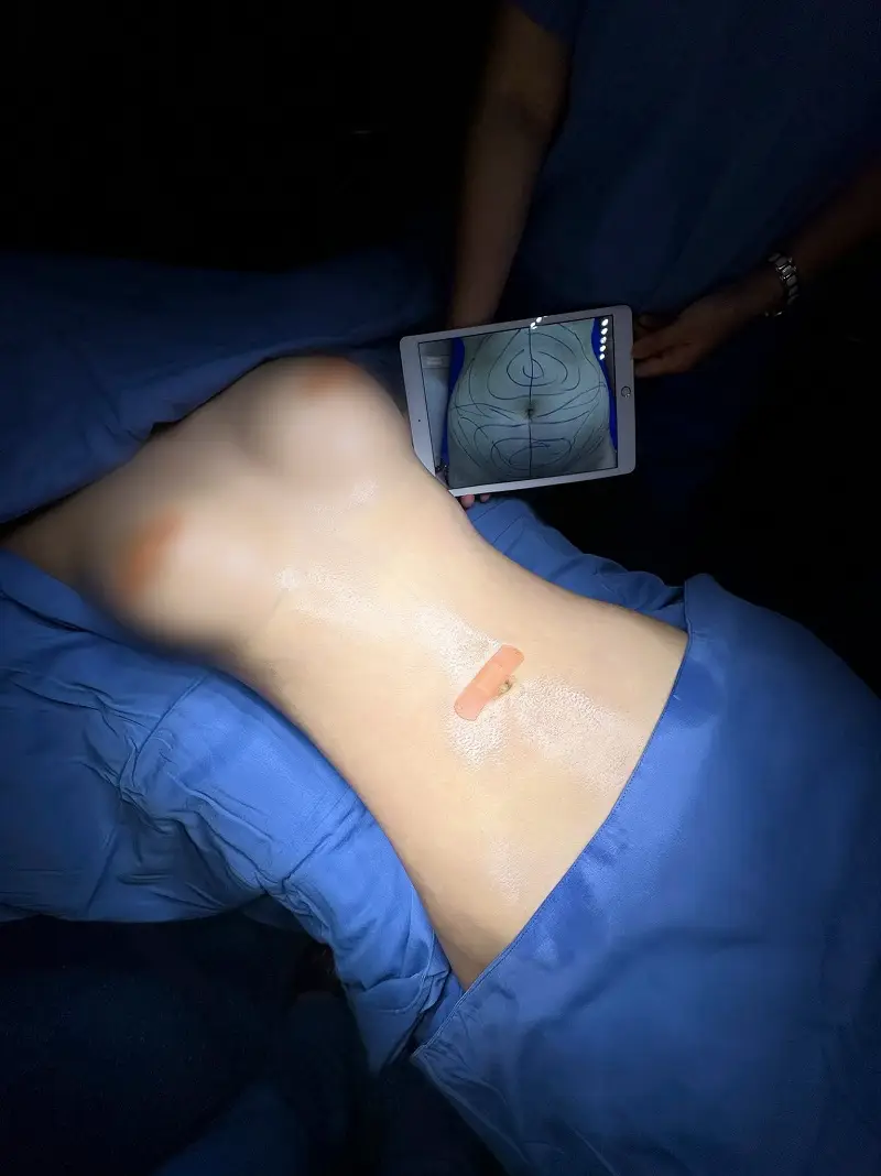 Phương pháp hút mỡ bụng cấy vào ngực giúp cải thiện tình trạng ngực lép và mang lại vòng eo thon gọn