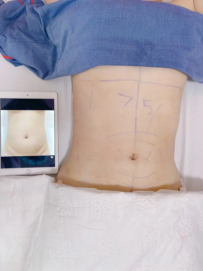 Hút mỡ bụng mang lại hiệu quả lâu dài