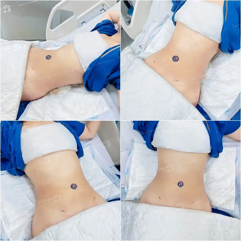 Vùng bụng cần có thời gian hồi phục và ổn định sau hút mỡ