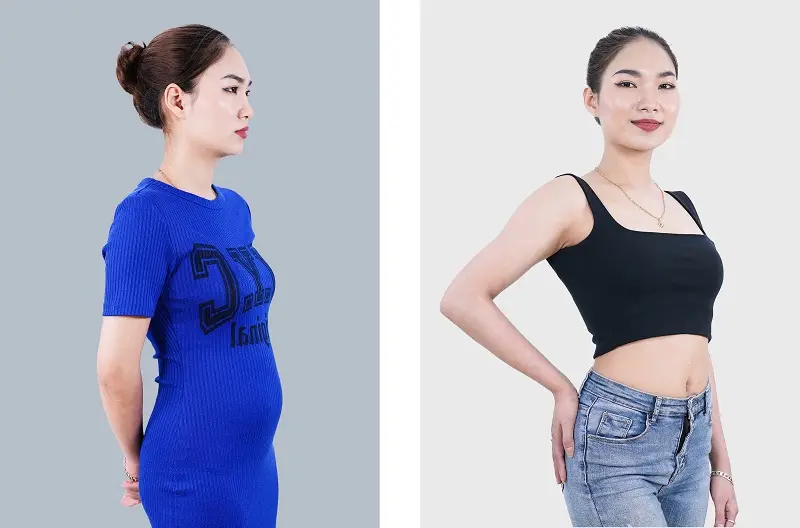 Sau sinh con nhiều chị em đã lấy được vóc dáng thon gọn nhờ hút mỡ bụng