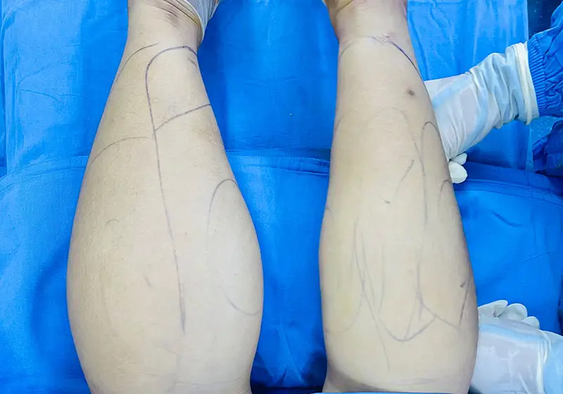 Hút mỡ chân có độ an toàn cao khi được thực hiện tại địa chỉ thẩm mỹ uy tín