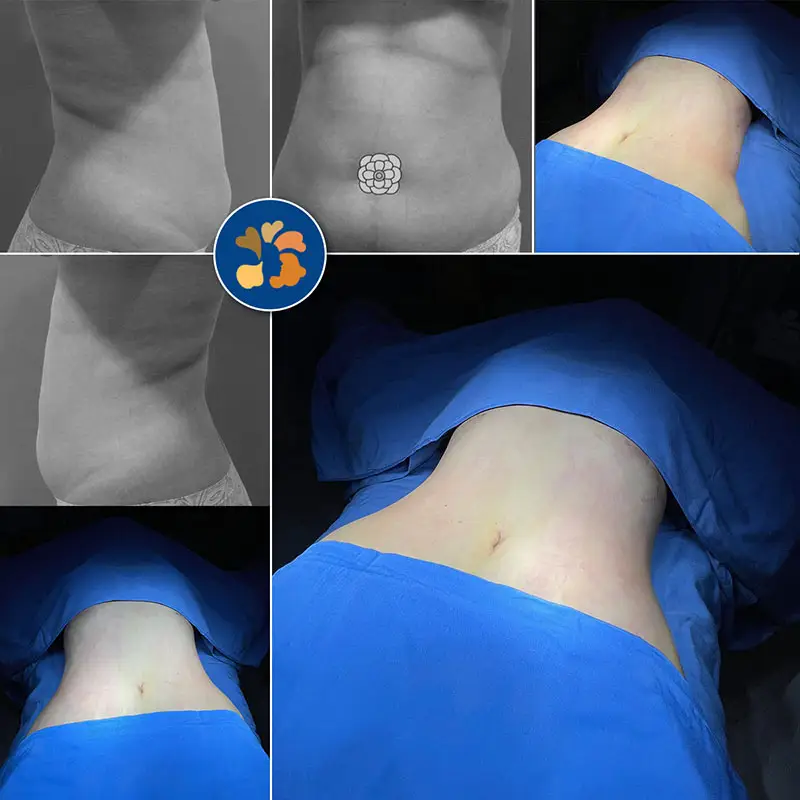 Hút mỡ giảm béo giúp định hình đường cong vòng eo