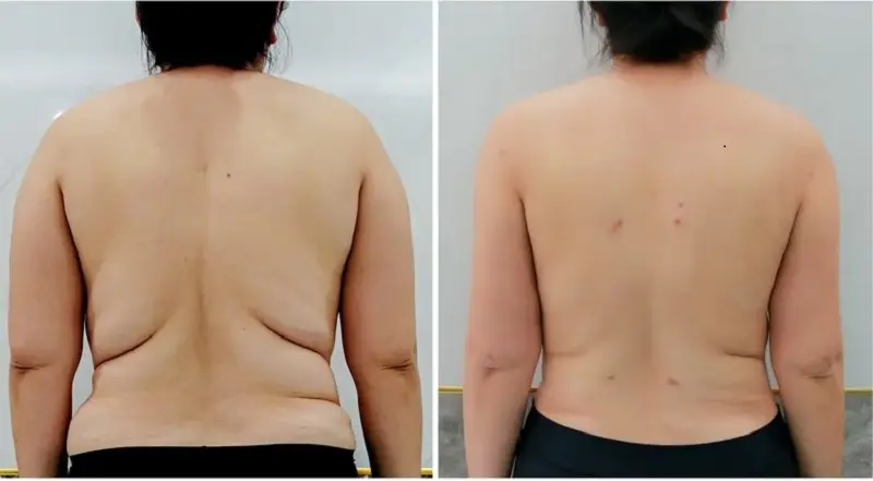 Hút mỡ lưng giúp vùng lưng thon gọn, săn chắc hơn