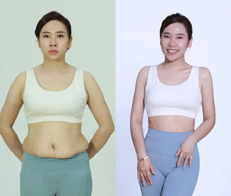 Giảm mỡ toàn thân giúp khách hàng sở hữu thân hình thon gọn