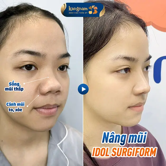 Dáng mũi hài hòa, tự nhiên sau phẫu thuật