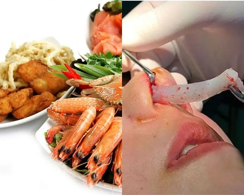 Kiêng một số món ăn sau khi tháo sụn mũi
