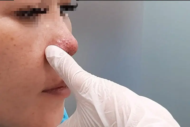 Mũi sưng có thể do viêm, nhiễm trùng