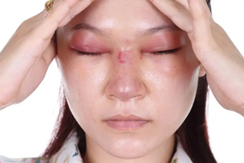 Sưng sau nâng mũi 1 tháng