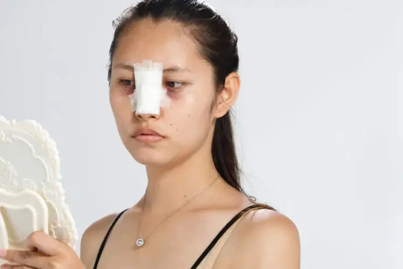 Can thiệp sửa lại mũi quá sớm có thể khiến mũi tổn thương