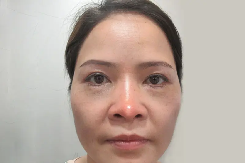 Mũi sưng nhẹ sau 2 tháng phẫu thuật