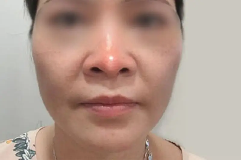Nâng mũi sau 3 tháng bị sưng là dấu hiệu bất thường