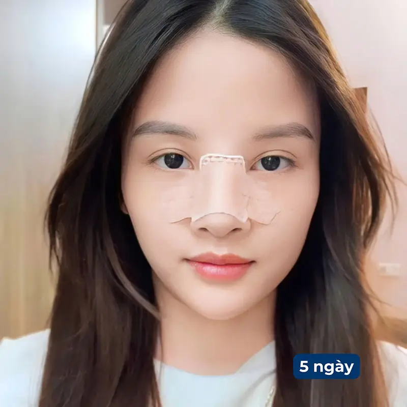 Sau nâng mũi cần nghỉ ngơi 7 đến 10 ngày