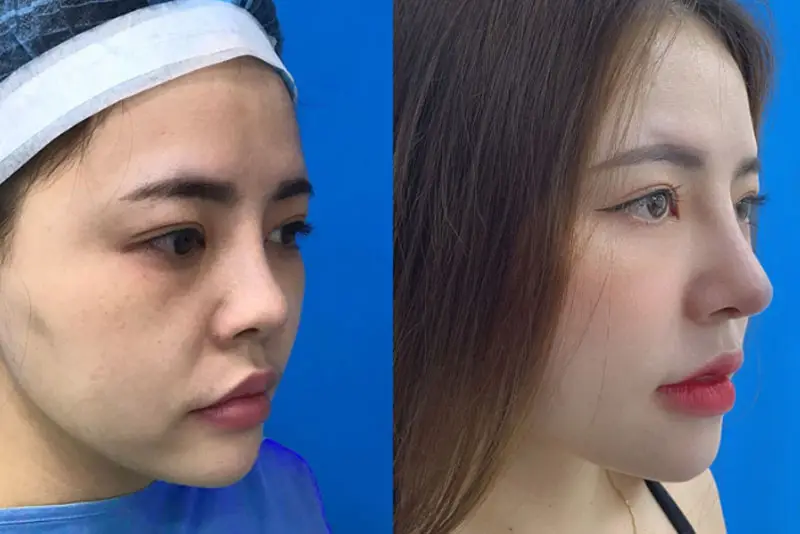 Dáng mũi tự nhiên, mềm mại sau nâng mũi sụn Mỹ