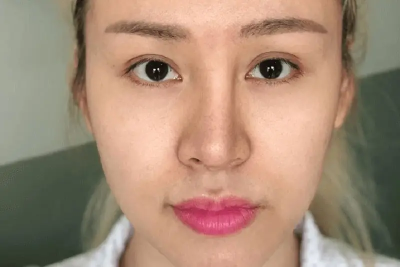 Nâng mũi bị lệch không thể nắn chỉnh