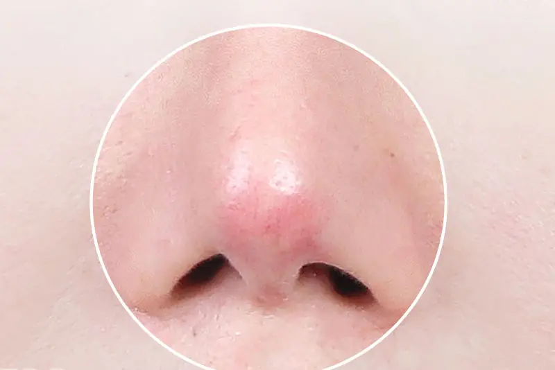 Nâng mũi bọc sụn đỏ đầu mũi