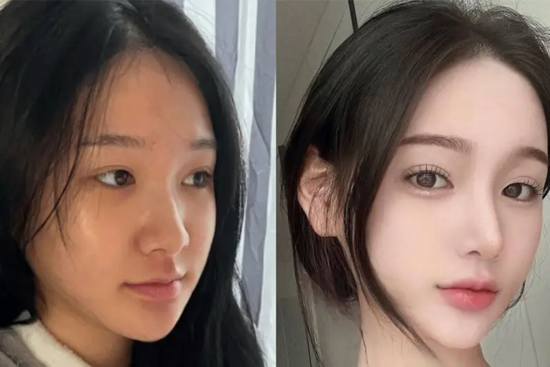 Đầu mũi mềm mại, không bóng đỏ, không lộ sụn