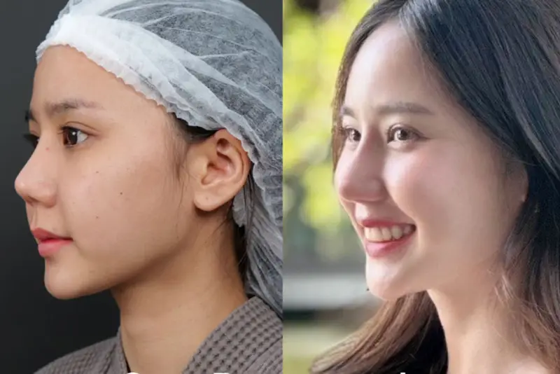 Mũi vào form hoàn chỉnh, dáng mũi tự nhiên