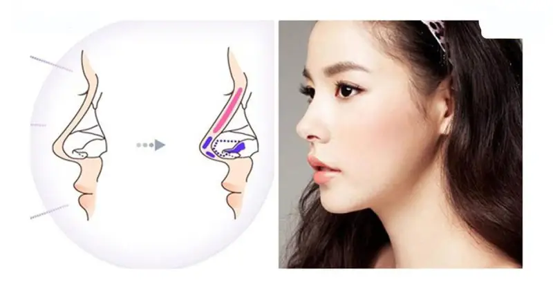 Nâng mũi bọc sụn Megaderm