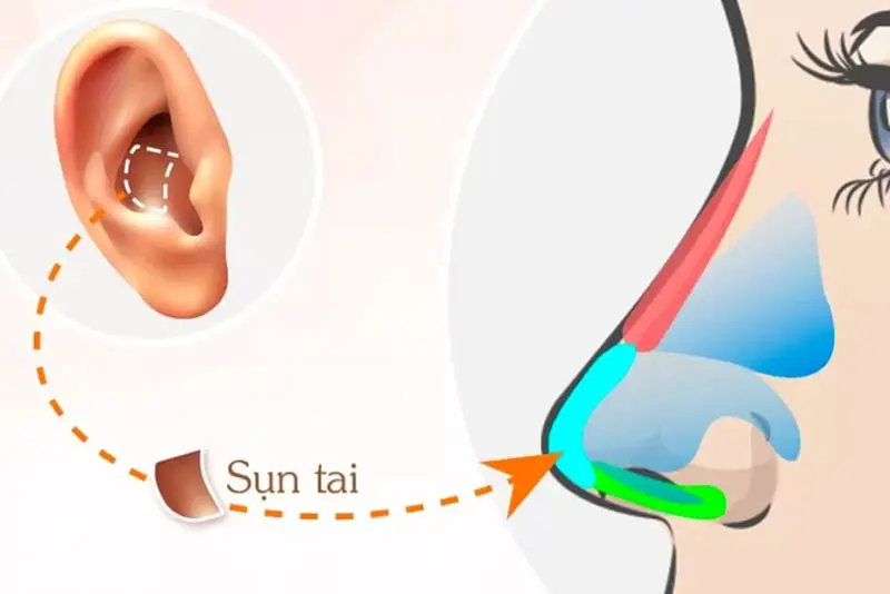 Nâng mũi cấu trúc sụn tai