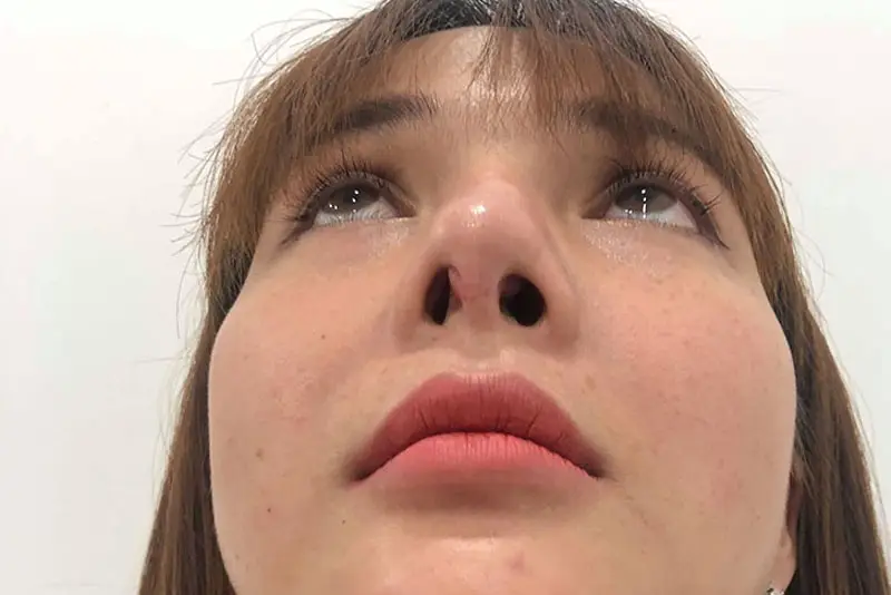 Cần thăm khám sớm nếu nhận thấy mũi bị lòi sụn