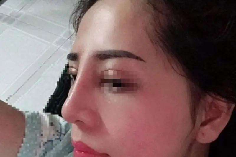 Không nâng mũi quá cao, tránh biến chứng