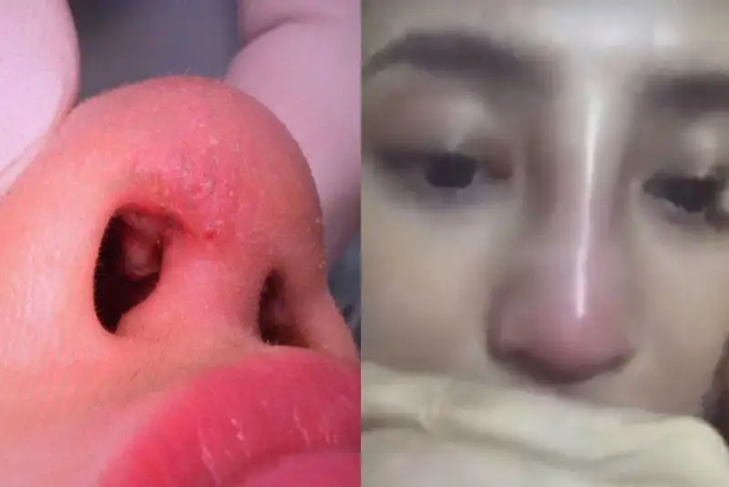 Mũi sưng sau 3 tháng phẫu thuật có thể do bác sĩ thực hiện sai kỹ thuật