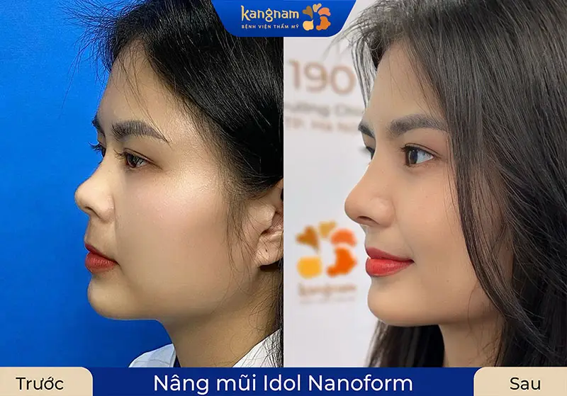 Nâng mũi cấu trúc cải thiện mũi hếch toàn diện