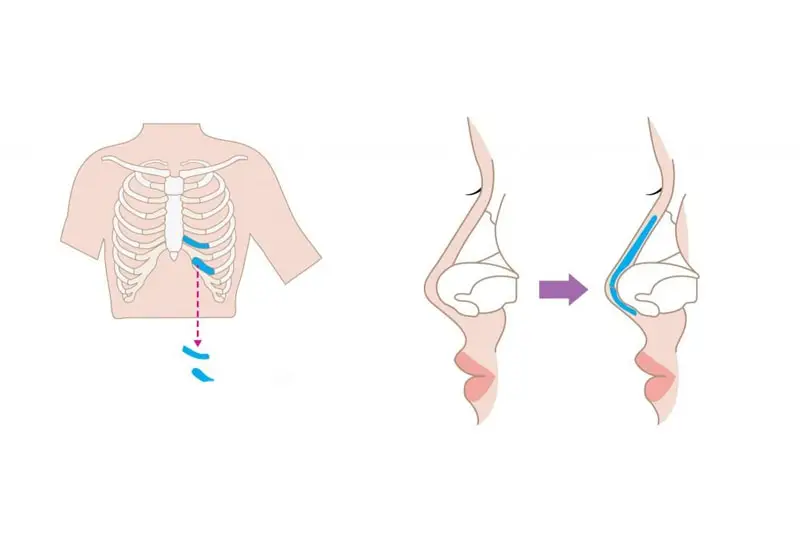Nâng mũi sụn sườn tương thích tốt, an toàn