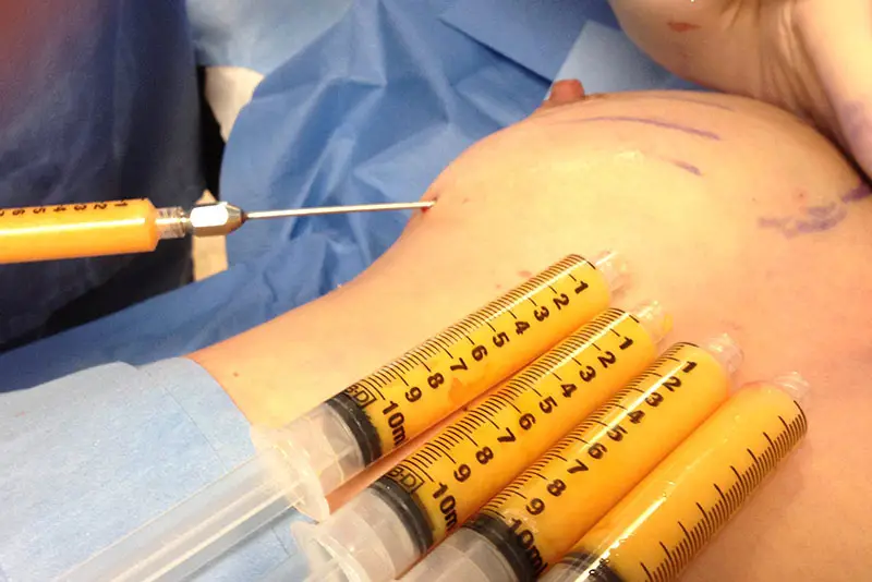 nâng ngực mỡ tự thân