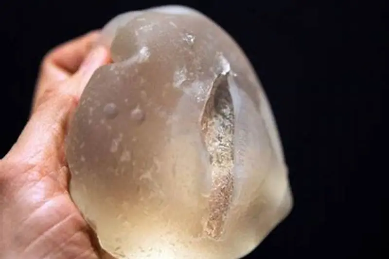 Túi ngực có thể bị rò rỉ hoặc vỡ