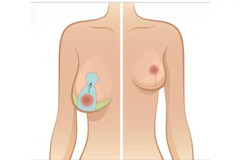 nâng ngực chảy xệ sau sinh giá bao nhiêu