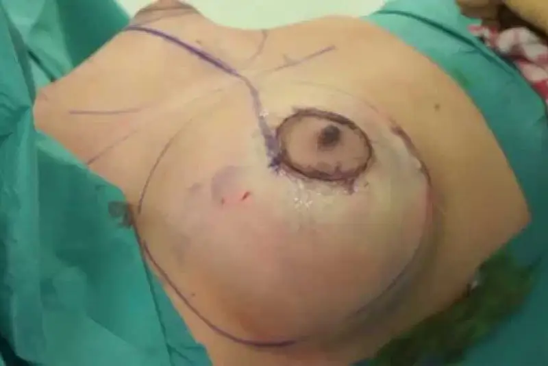 Nâng ngực đường quầng vú